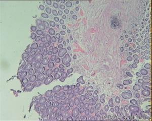 乙状结肠息肉图3