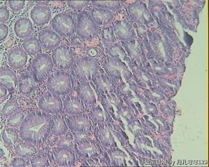 乙状结肠息肉图12