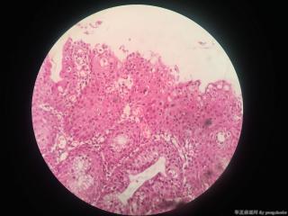 宫颈息肉伴鳞化，有异性增生和挖空细胞吗？图6