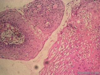 尖锐湿疣？高度病变？图3