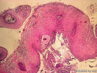尖锐湿疣？高度病变？图1