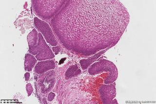 膀胱三角区占位，腺性膀胱炎伴鳞化？图2