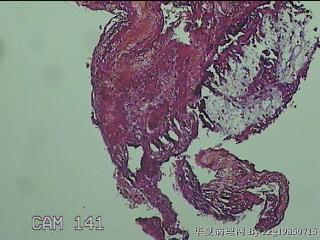 宫颈赘生物图13