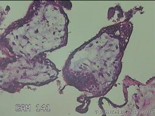 宫颈赘生物图46