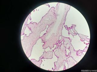 稽留流产，绒毛水肿？图6
