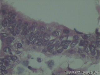 子宫内膜增生伴不典型增生还是子宫内膜样腺癌？图8