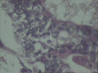 子宫内膜增生伴不典型增生还是子宫内膜样腺癌？图18