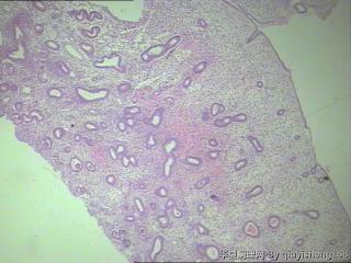 宫内膜--息肉？图8