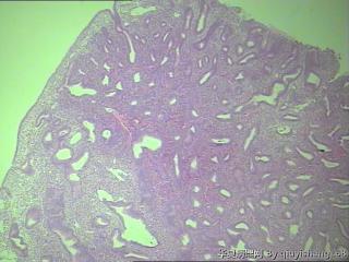 宫内膜--息肉？图1
