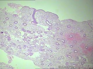 宫内膜--息肉？图4