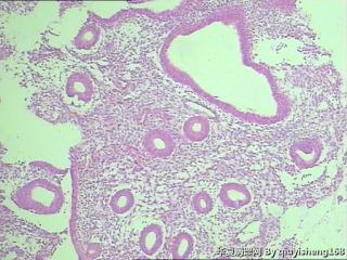 宫内膜活检--增生紊乱？图10