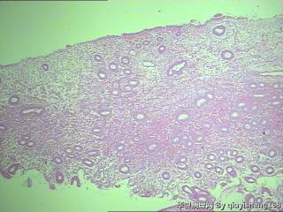 宫内膜活检--增生紊乱？图1