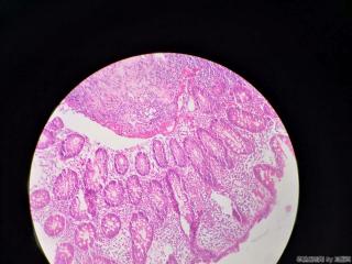 结肠活检图11