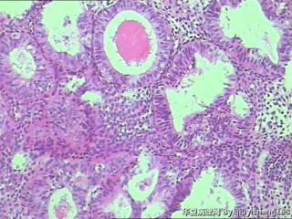 宫内膜活检--单纯性增生？图9