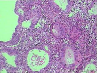宫内膜活检--单纯性增生？图8