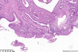 宫颈赘生物图8