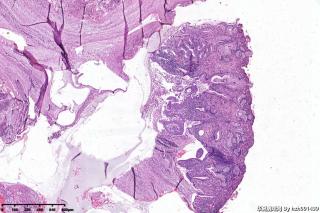 宫颈赘生物图5