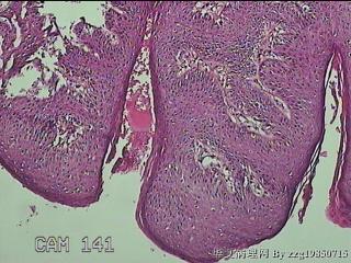 后联合赘生物图18