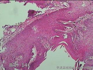 后联合赘生物图10