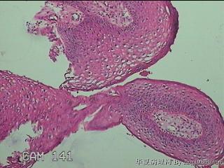 右侧小阴唇赘生物图14