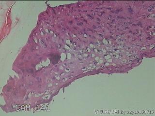 右侧小阴唇赘生物图26