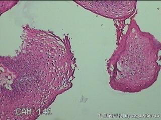 右侧小阴唇赘生物图15