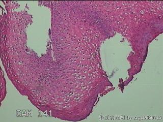 右侧小阴唇赘生物图9