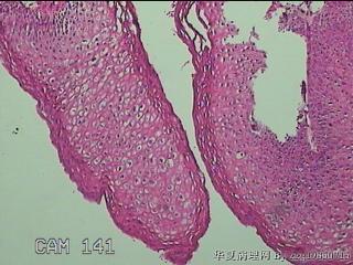 右侧小阴唇赘生物图7