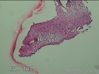 右侧小阴唇赘生物图17