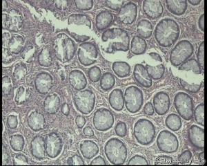急！请老师看看直肠息肉，今天发报告图9