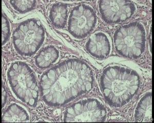 急！请老师看看直肠息肉，今天发报告图11