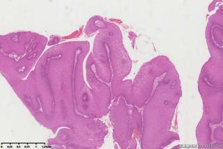 宫颈赘生物，尖锐湿疣？图12