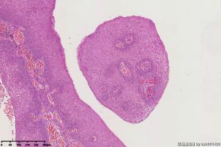 宫颈赘生物，尖锐湿疣？图4
