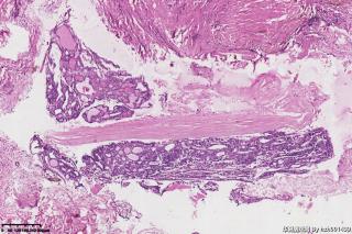 请老师们帮看看这个畸胎瘤里的这些成份是否都是甲状腺组织，有问题吗？图17