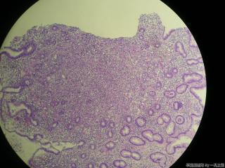 胃窦粘膜活检图14