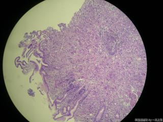胃窦粘膜活检图11
