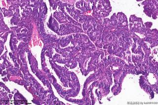 高分化子宫内膜样腺癌？图29
