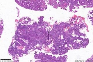 高分化子宫内膜样腺癌？图16