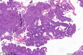 高分化子宫内膜样腺癌？图19