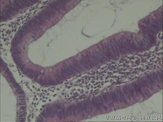 直肠管状腺瘤？图6