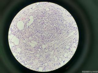 纤维脂肪瘤继发肉芽肿性炎？  还是其他？图11