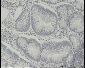 请老师帮忙看看横结肠巨大息肉图13