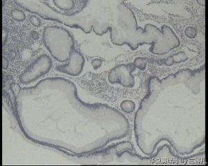 请老师帮忙看看横结肠巨大息肉图5