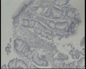 请老师帮忙看看横结肠巨大息肉图11