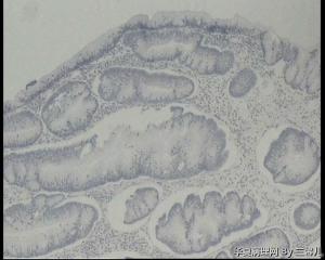 请老师帮忙看看横结肠巨大息肉图9