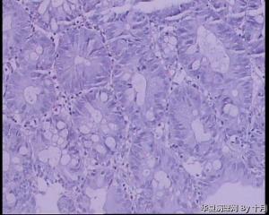 请教：结肠息肉。图15