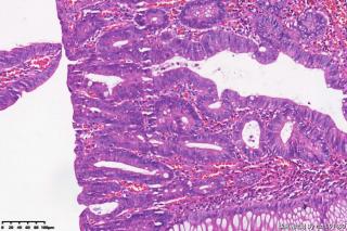 乙状结肠息肉，请教有高级别吗？图24