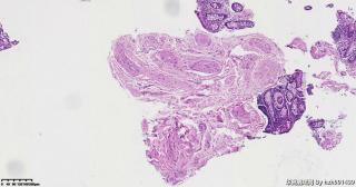 乙状结肠粘膜，临床疑肿瘤，上皮没事，请帮看看这些间质图11