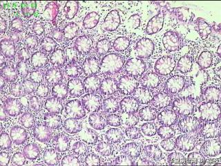 结肠活检组织，请教？图3