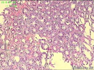 结肠活检组织，请教？图1